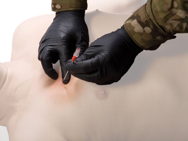 TyTek® Medical T-PAK Dekompressionsnadel / Pneumothoraxentlastungsnadel | Größe: 14 G